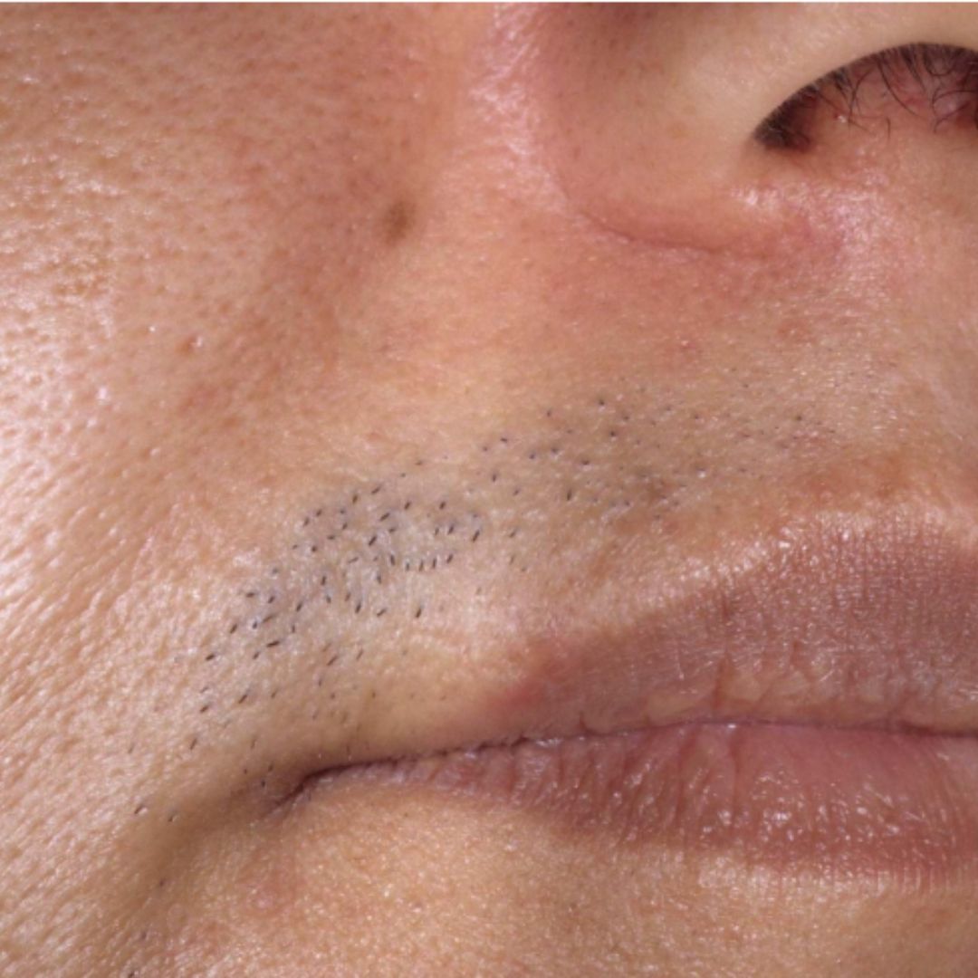 Ontharen boven lip voor